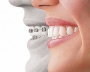 Invisalign Sherman oaks