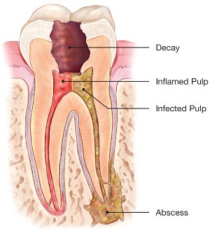 Root canals Beverly Hills