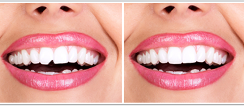 Dental bonding Beverly Hills
