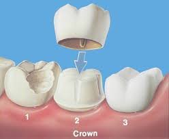 Dental crown Beverly Hills