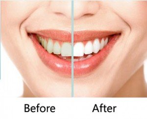 zoom teeth whitening Beverly Hills