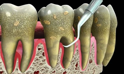 Periodontal treatment Beverly Hills