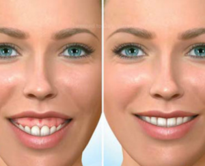 gummy smile treatment beverly hills ca