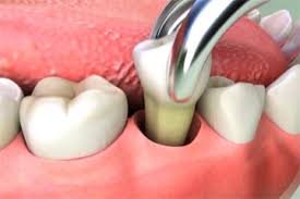 Tooth extraction Beverly Hills