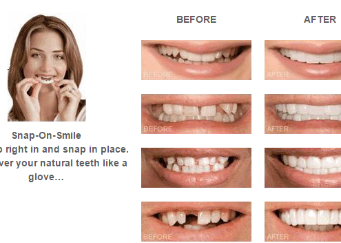 Snap On Smile Beverly Hills